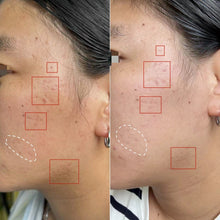 Load image into Gallery viewer, New CarbonLaze Fractional Co2 Laser Skin Resurfacing Machine