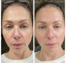 Load image into Gallery viewer, New IndeePlus 448kHz PRO Capacitive Cupping, Vacuum Pressure and RF Diathermy Machine for Facial Rejuvenation, Body Contouring, Cellulite Reduction and Physiotherapy