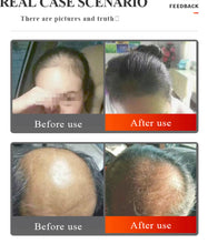 Load image into Gallery viewer, New LocksLaze Laser Diode Hair Restoration Growth Comb