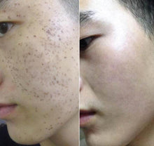 Load image into Gallery viewer, New JuvaRase Tattoo Removal and Skin Rejuvenation Machine