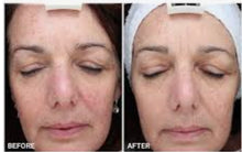 Load image into Gallery viewer, New JuvaX PRO Multi LED Skincare Mask with Microcurrent