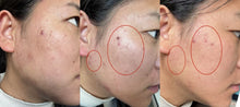 Load image into Gallery viewer, New CarbonLaze Fractional Co2 Laser Skin Resurfacing Machine