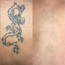 Load image into Gallery viewer, New JuvaRase Tattoo Removal and Skin Rejuvenation Machine