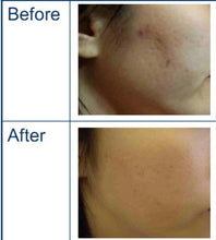 Load image into Gallery viewer, Pinxel 5 Portable Microneedling and Fractional RF Skincare Machine