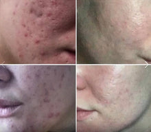 Load image into Gallery viewer, Pinxel 5 Portable Microneedling and Fractional RF Skincare Machine