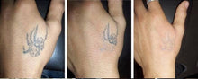 Load image into Gallery viewer, New JuvaRase Tattoo Removal and Skin Rejuvenation Machine