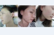 Load image into Gallery viewer, New JuvaRase Tattoo Removal and Skin Rejuvenation Machine