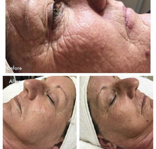 Load image into Gallery viewer, New IndeePlus 448kHz PRO Capacitive Cupping, Vacuum Pressure and RF Diathermy Machine for Facial Rejuvenation, Body Contouring, Cellulite Reduction and Physiotherapy