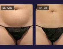 Load image into Gallery viewer, 2024 JuvaShape Android 6 Technology Non Surgical Fat Reduction Body Contouring Cellulite Removal Cosmetic System
