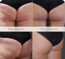 Load image into Gallery viewer, 2024 JuvaShape Android 6 Technology Non Surgical Fat Reduction Body Contouring Cellulite Removal Cosmetic System