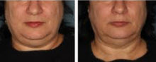 Load image into Gallery viewer, 2024 JuvaShape Android 6 Technology Non Surgical Fat Reduction Body Contouring Cellulite Removal Cosmetic System