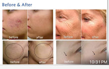 Load image into Gallery viewer, Glowskin Hot Springs O+ 2 in 1 Carbon Oxygen Facial Beauty Machine