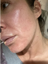 Load image into Gallery viewer, New TIXEL RF Microneedling and Cold Hammer Skin Resurfacing System