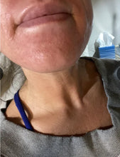 Load image into Gallery viewer, New TIXEL RF Microneedling and Cold Hammer Skin Resurfacing System