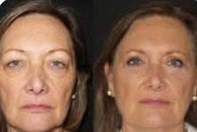Load image into Gallery viewer, 2025 DermaElectroporation DEP Needle Free Skin Rejuvenation Machine