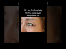 Load and play video in Gallery viewer, New CarbonLaze Fractional Co2 Laser Skin Resurfacing Machine