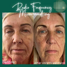 Load image into Gallery viewer, Pinxel VS RF Microneedling with Vacuum Air Chamber Skin Care Beauty Machine