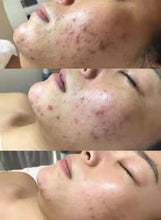 Load image into Gallery viewer, Pinxel VS RF Microneedling with Vacuum Air Chamber Skin Care Beauty Machine
