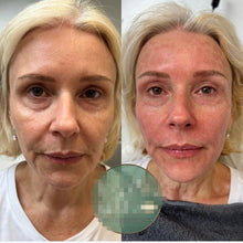 Load image into Gallery viewer, Pinxel VS RF Microneedling with Vacuum Air Chamber Skin Care Beauty Machine