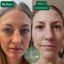 Load image into Gallery viewer, Pinxel VS RF Microneedling with Vacuum Air Chamber Skin Care Beauty Machine