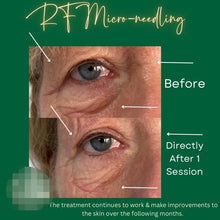 Load image into Gallery viewer, Pinxel VS RF Microneedling with Vacuum Air Chamber Skin Care Beauty Machine