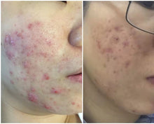 Load image into Gallery viewer, Pinxel VS RF Microneedling with Vacuum Air Chamber Skin Care Beauty Machine