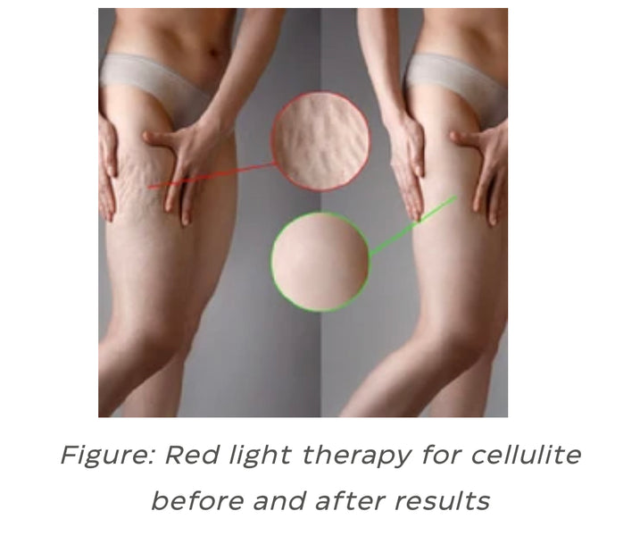 RED LIGHT THERAPY FOR CELLULITE: DOES IT REALLY WORK?