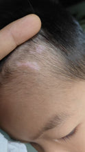 Load image into Gallery viewer, 2026 JuvaLamp Philips Professional BU-10 UVB Acne Vitiligo Psoriasis Eczema Lamp
