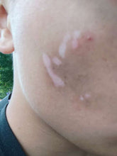Load image into Gallery viewer, 2026 JuvaLamp Philips Professional BU-10 UVB Acne Vitiligo Psoriasis Eczema Lamp

