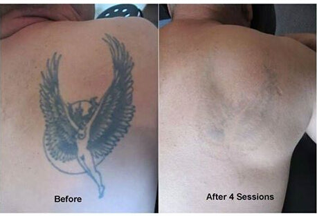 TOP 10 BEST Tattoo Removal in Norfolk, VA - January 2024 - Yelp