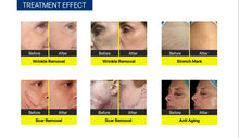 Load image into Gallery viewer, 2024 TIXEL RF Microneedling and Cold Hammer Skin Resurfacing System
