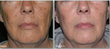 Load image into Gallery viewer, 2025 Lumi Glam PRO Android Dual Wavelength Thulium Fraxel Skin Rejuvenation Cosmetic Laser
