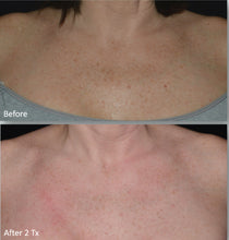 Load image into Gallery viewer, 2025 Lumi Glam PRO Android Dual Wavelength Thulium Fraxel Skin Rejuvenation Cosmetic Laser
