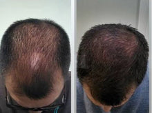 Load image into Gallery viewer, New JuvaLid Wireless Professional Red Light Therapy Hair Restoration Cap
