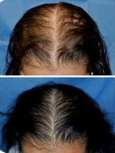 Load image into Gallery viewer, New JuvaLid Wireless Professional Red Light Therapy Hair Restoration Cap
