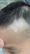 Load image into Gallery viewer, 2026 JuvaLamp Philips Professional BU-10 UVB Acne Vitiligo Psoriasis Eczema Lamp

