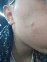 Load image into Gallery viewer, 2026 JuvaLamp Philips Professional BU-10 UVB Acne Vitiligo Psoriasis Eczema Lamp
