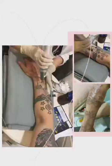 Laser Tattoo Removal near me - The Norwich Face & Body Clinic